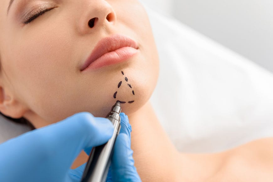 Chin Augmentation