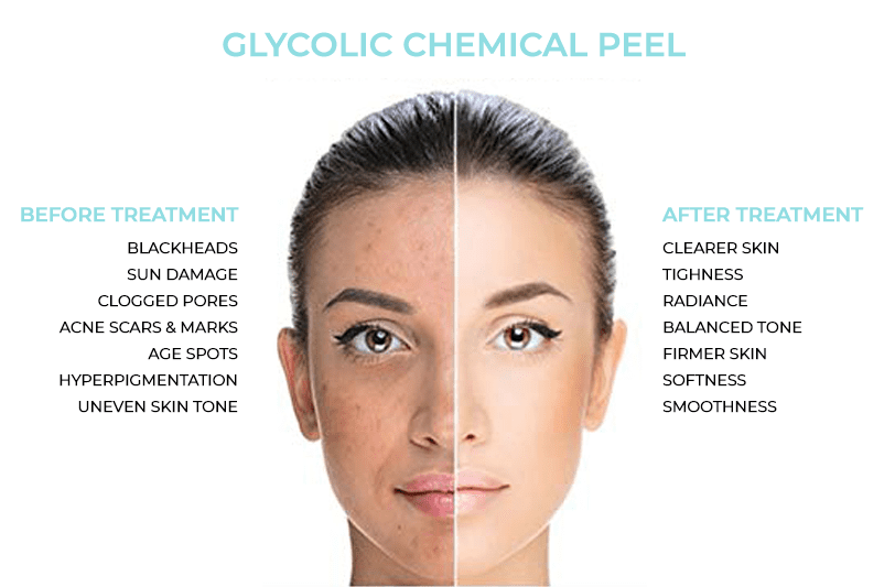 Glycolic Chemical Peel Treatment
