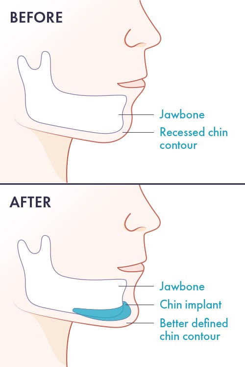 Chin Augmentation Procedures