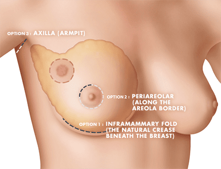 Breast Augmentation Procedure Options